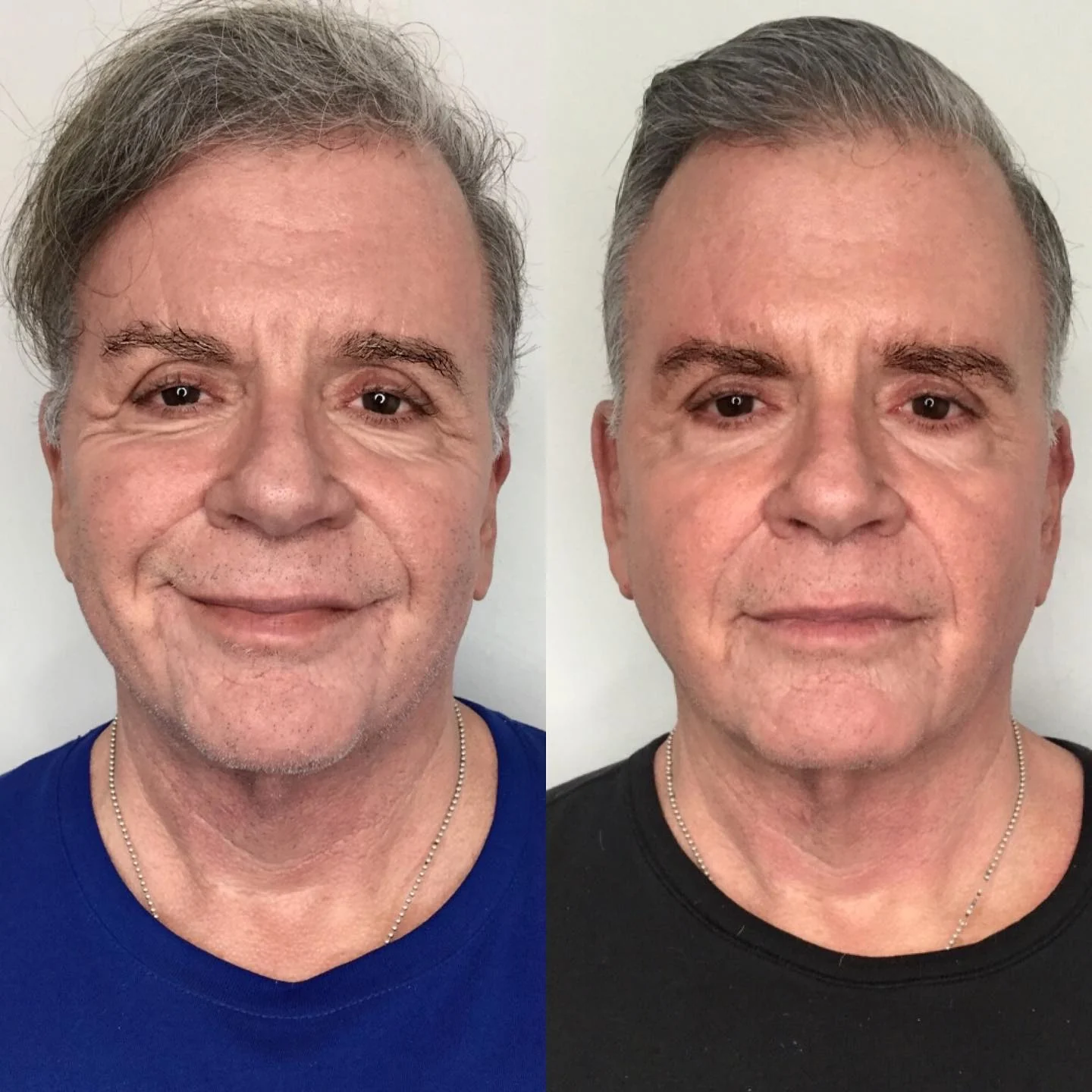 Before and after Daxxify at Femme Aesthetics, front view