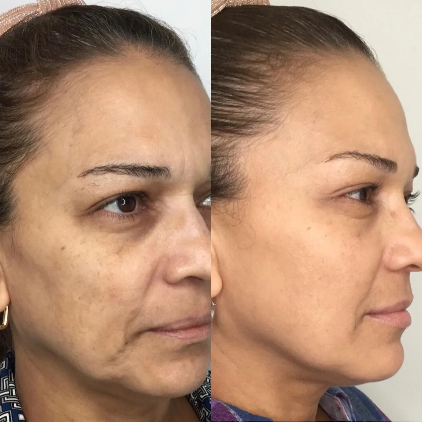 Before and after Morpheus8 at Femme Aesthetics, three-quarter view