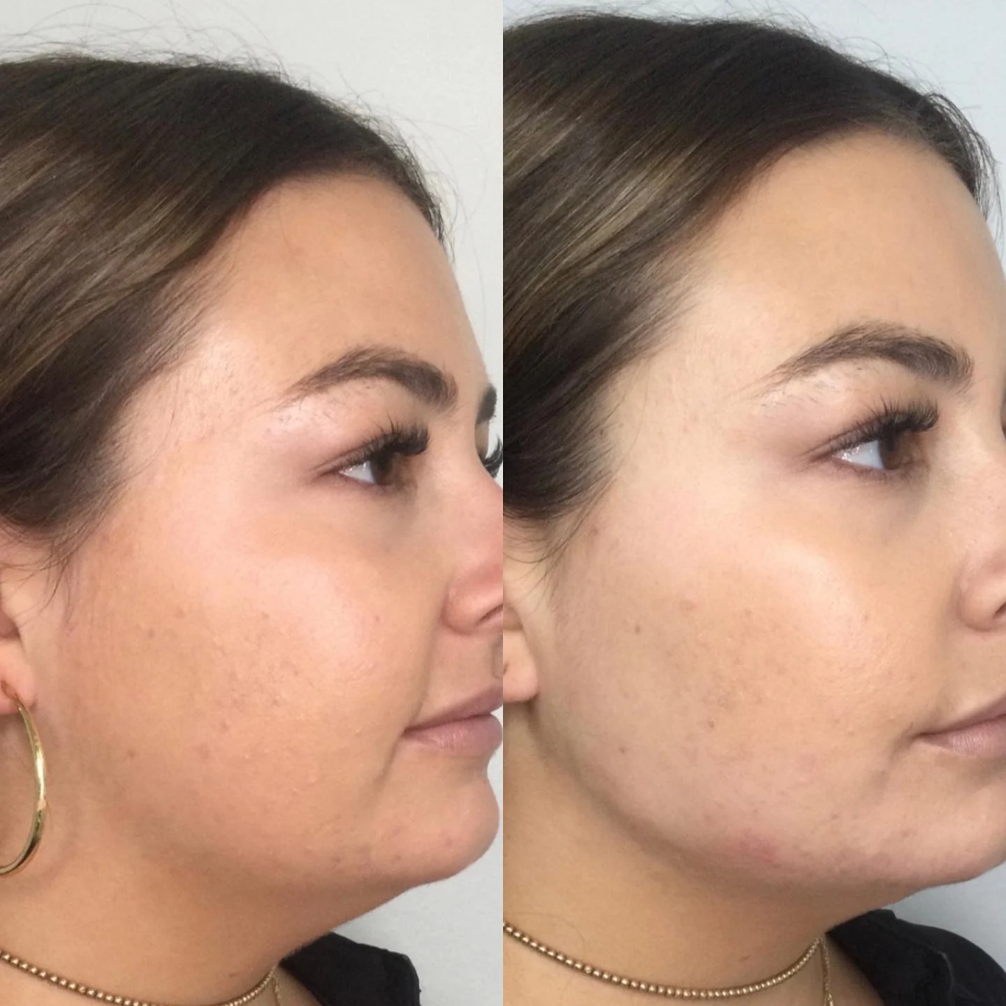 Before and after Radiesse at Femme Aesthetics, three-quarter view