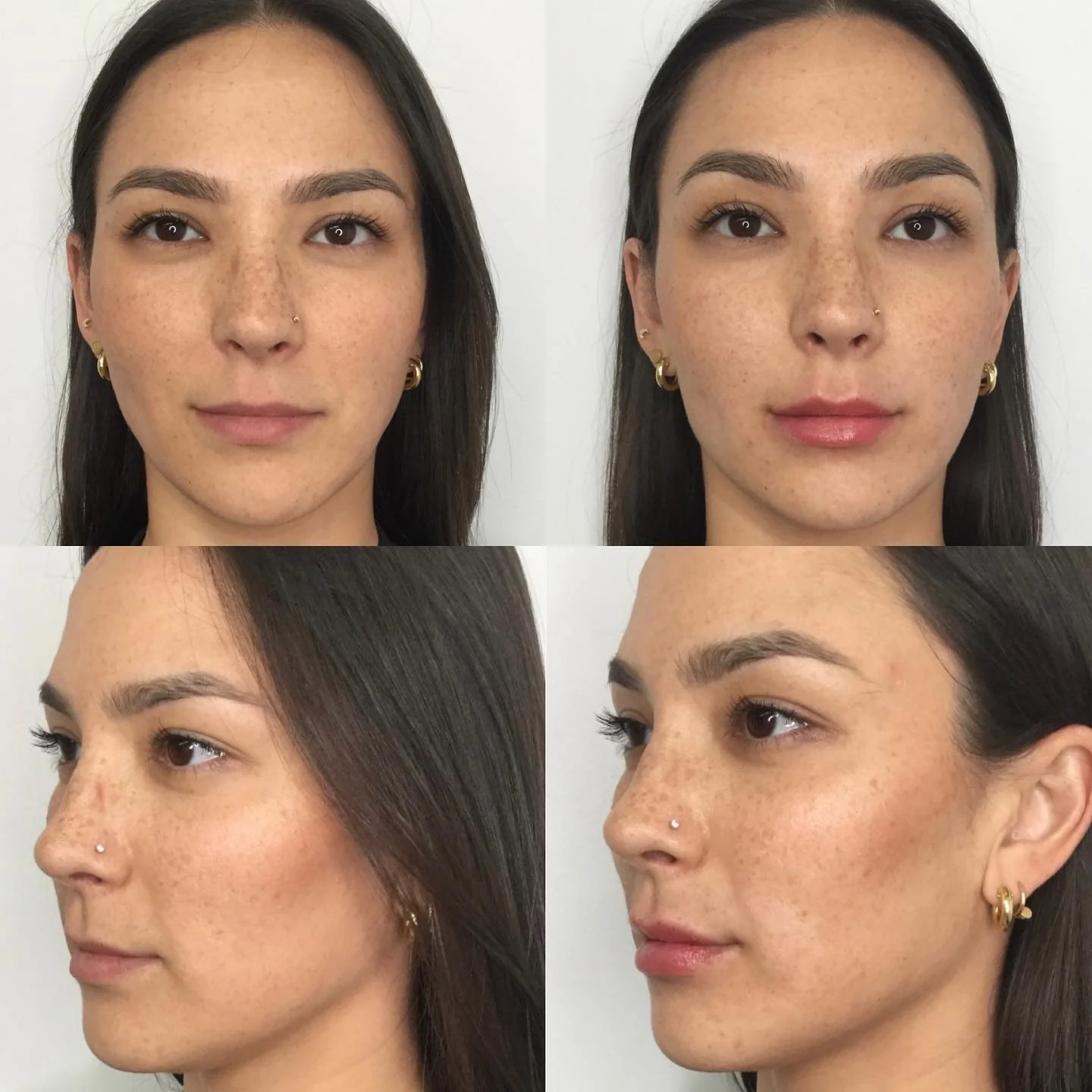 Before and after RHA lip filler at Femme Aesthetics, front and three-quarter views